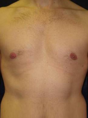 Male Breast Reduction Case 1 After