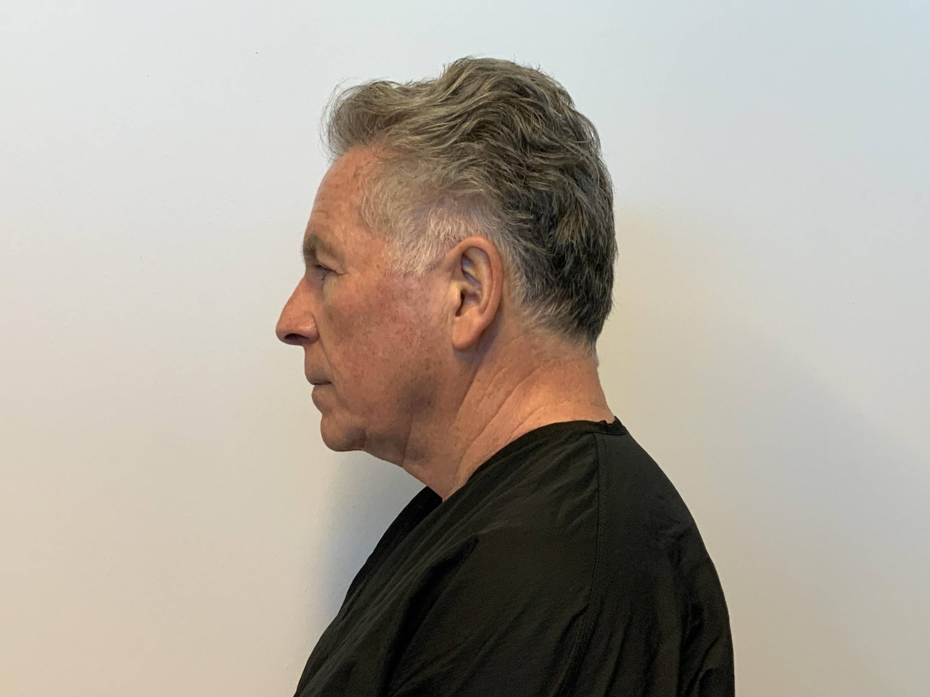 Facelift, necklift and upper and lower blepharoplasty Before