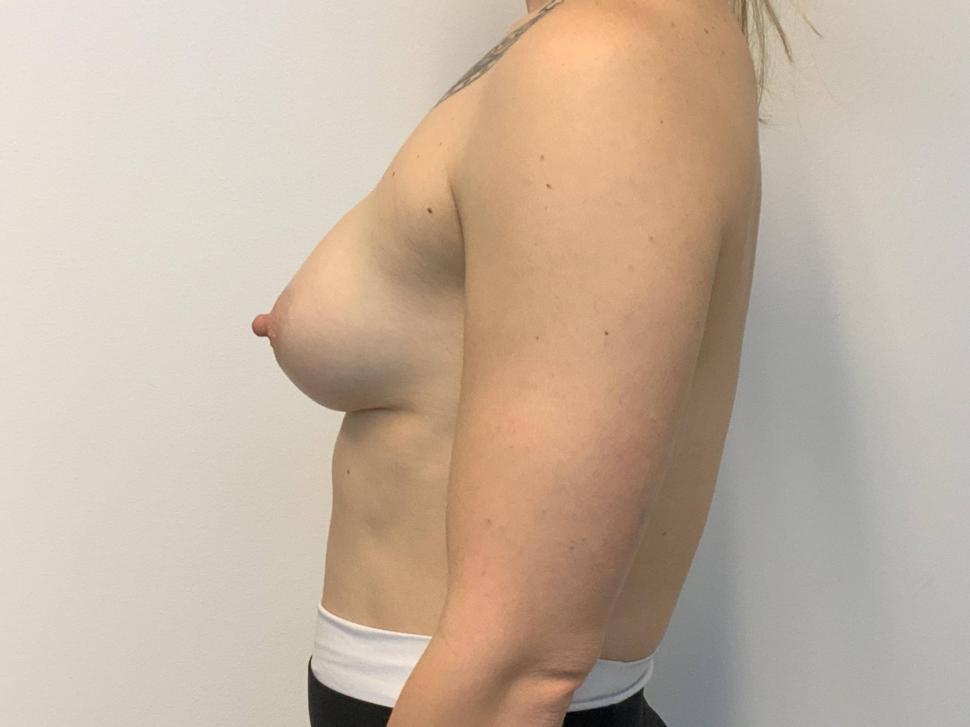 Breast Augmentation with Motiva After