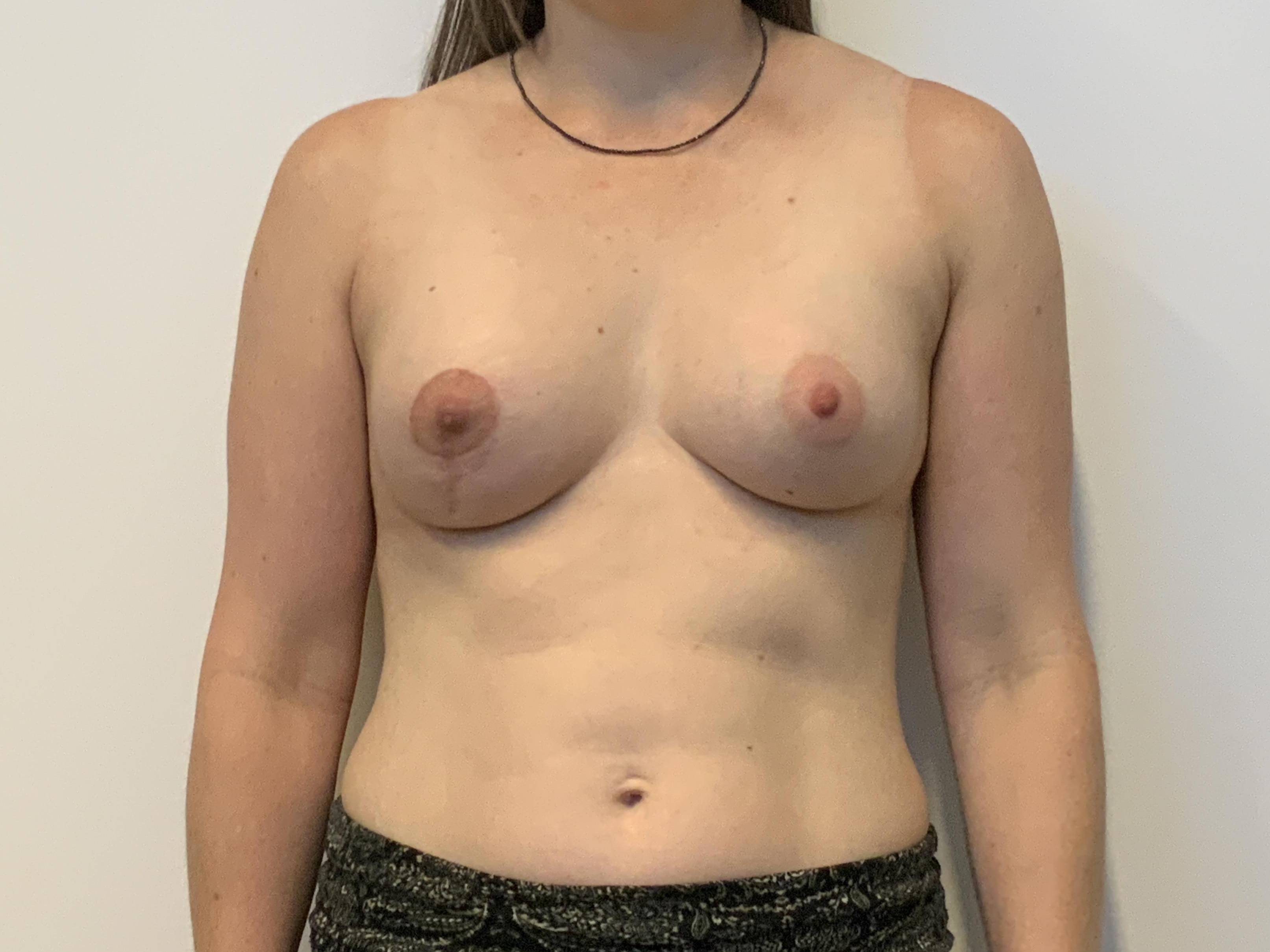 Breast augmentation with mastopexy left breast After