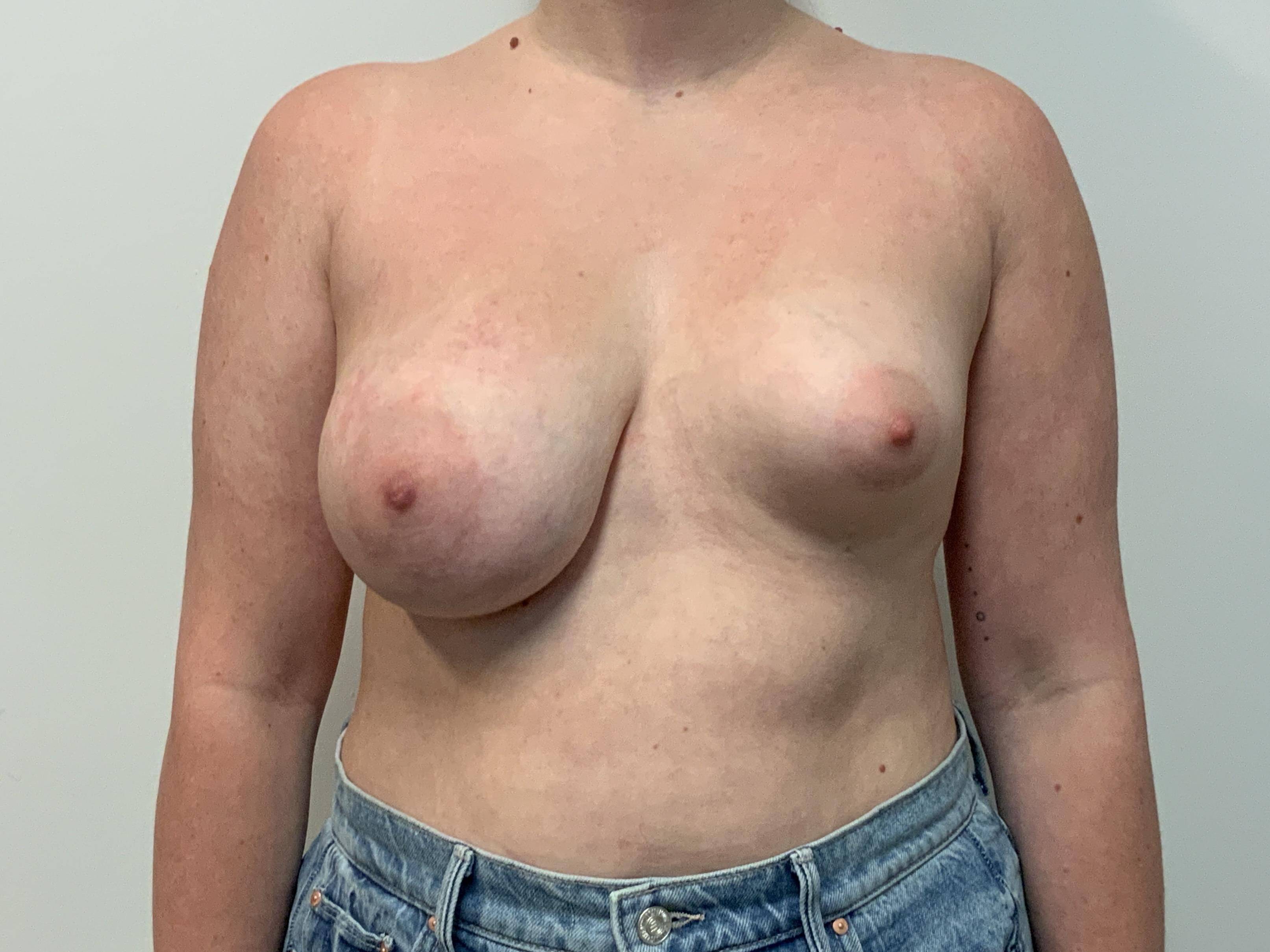 Breast Asymmetry Correction Before