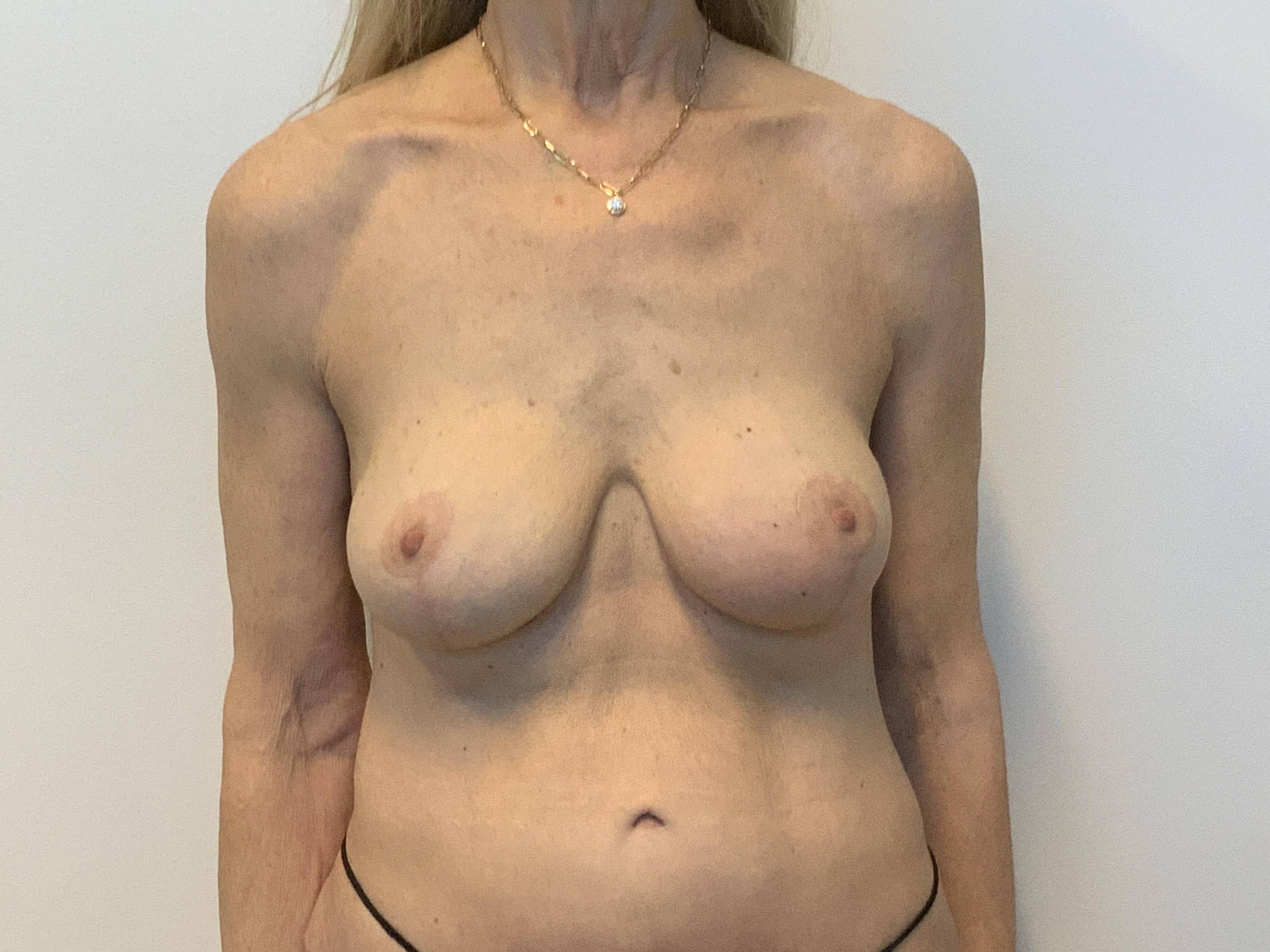 Implant exchange and lift After