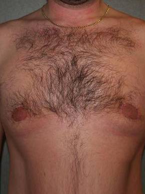 Male Breast Reduction Case 2 After