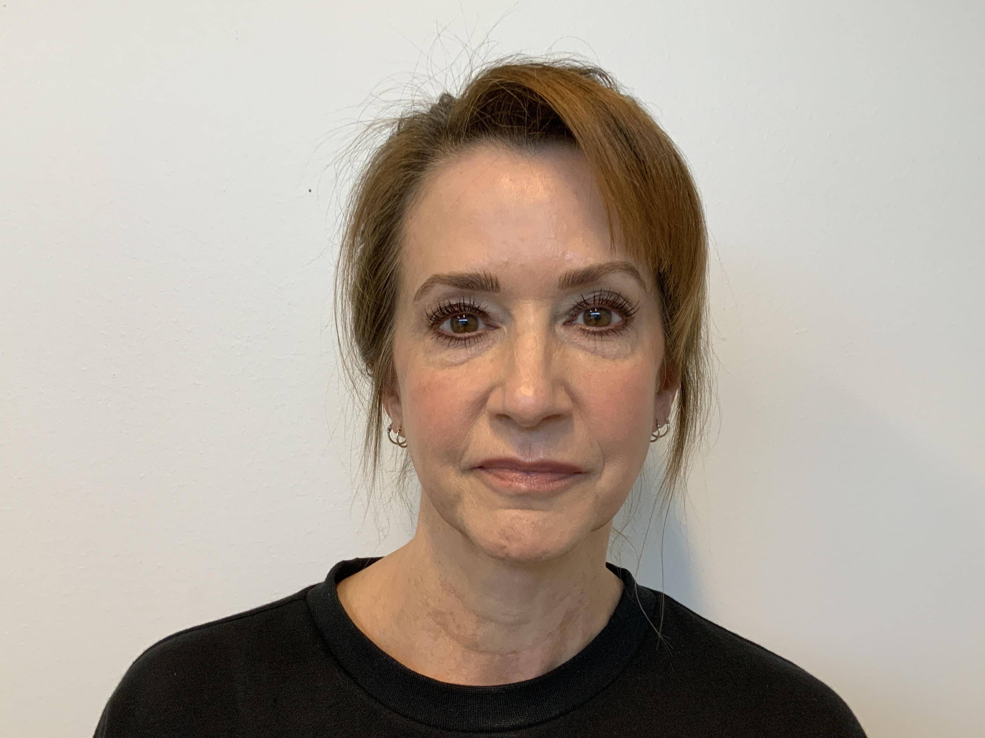 Upper and Lower Blepharoplasty Before
