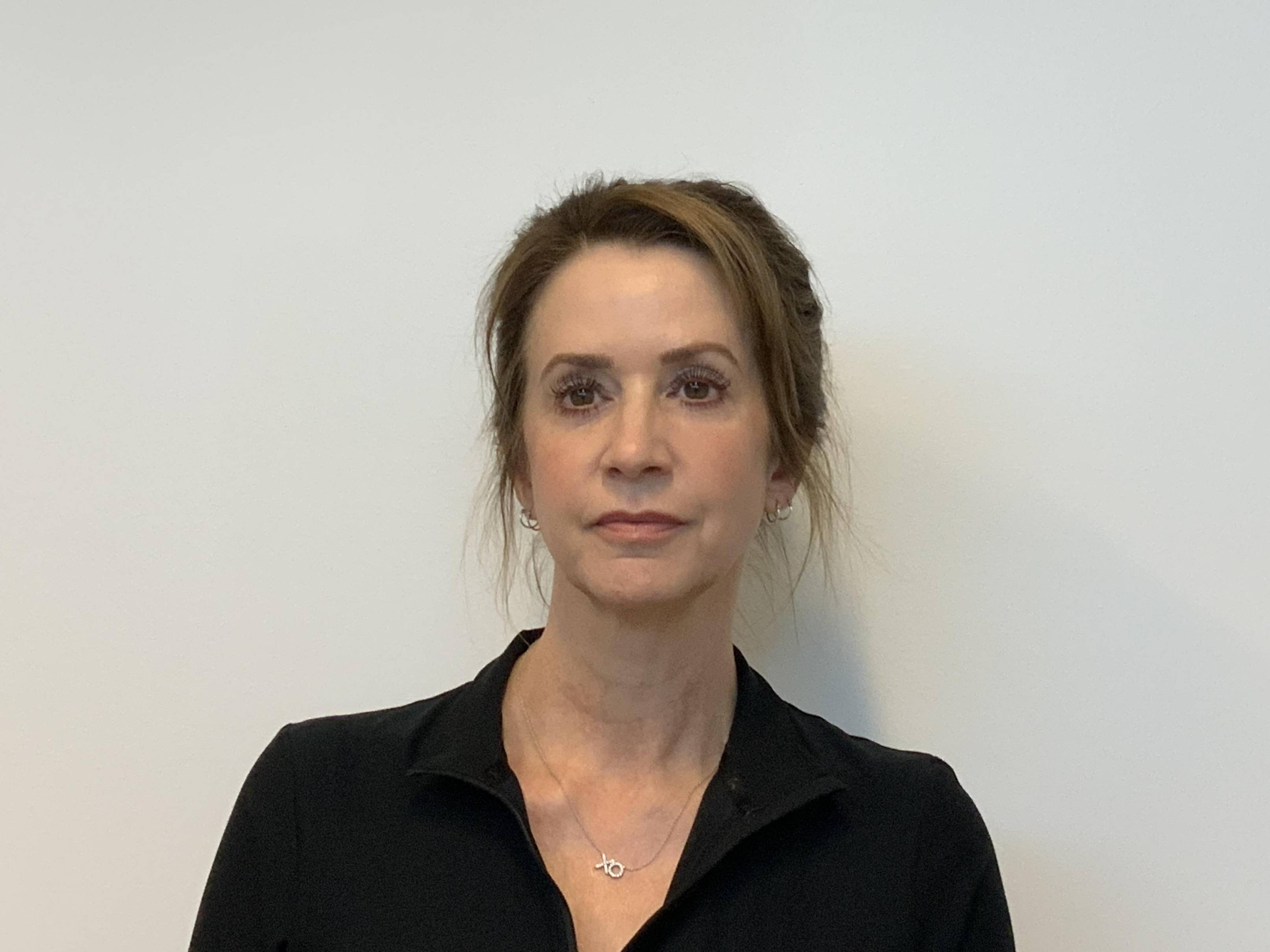 Upper and Lower Blepharoplasty After