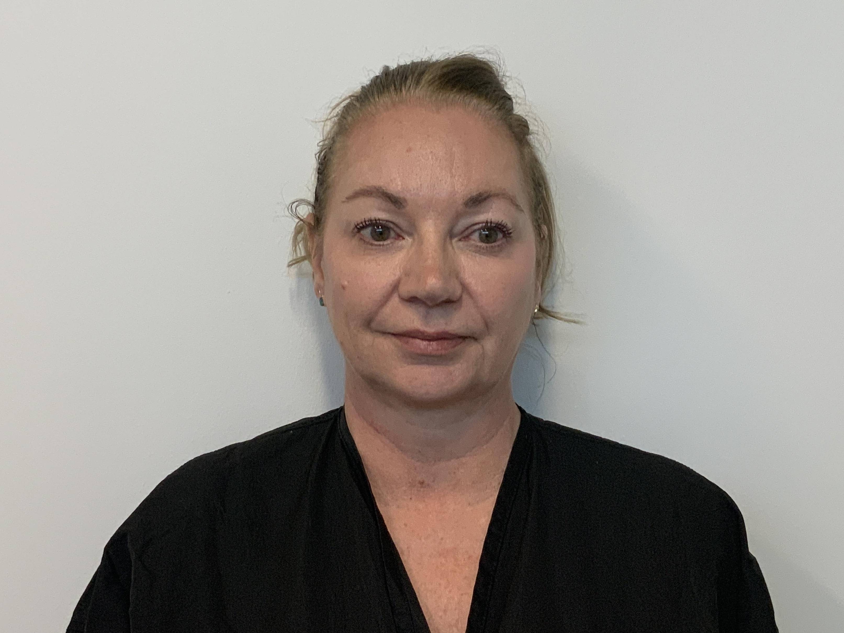 Facelift and neck lift with upper and lower blepharoplasty Before