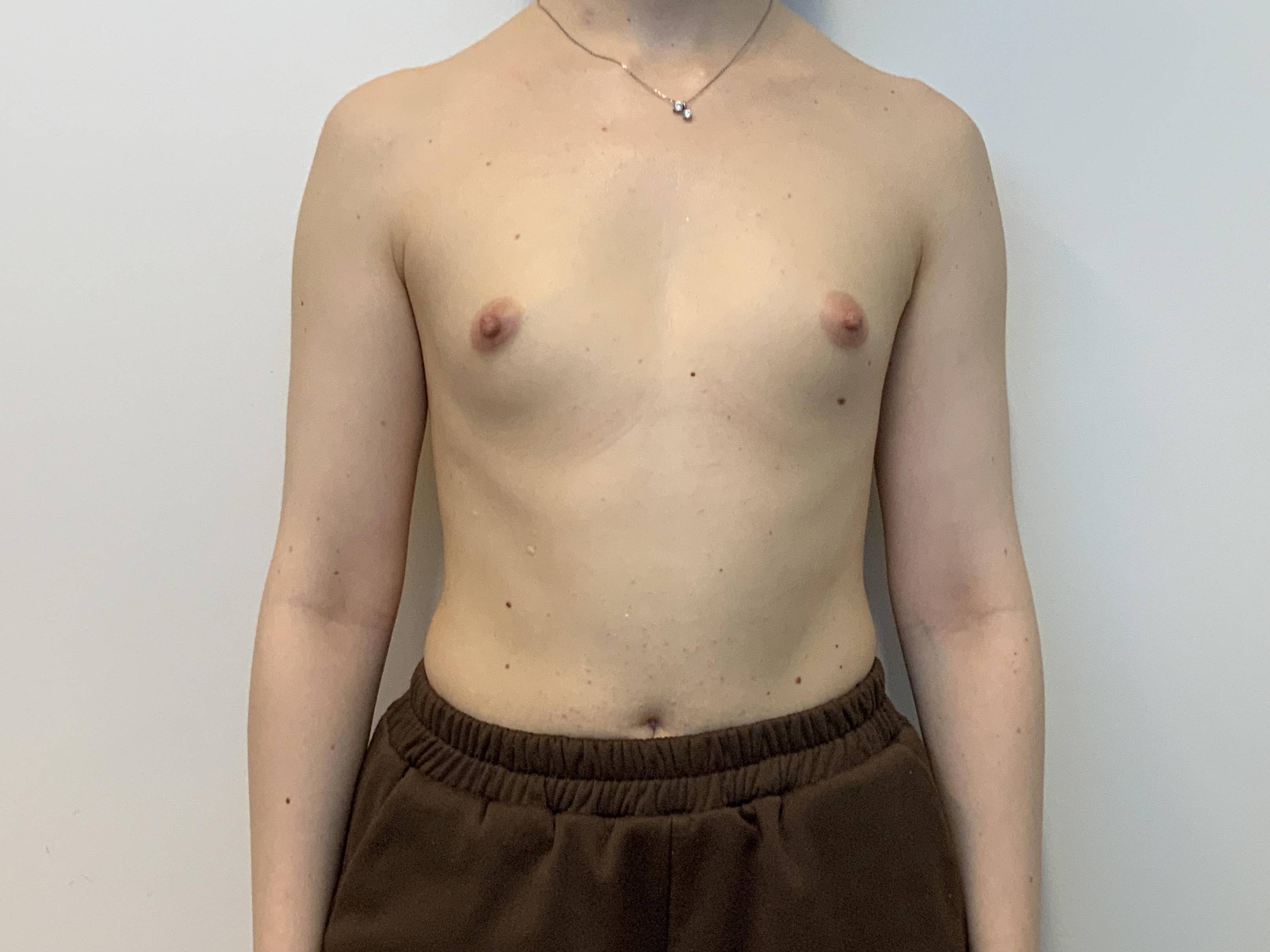 Breast Aug Before