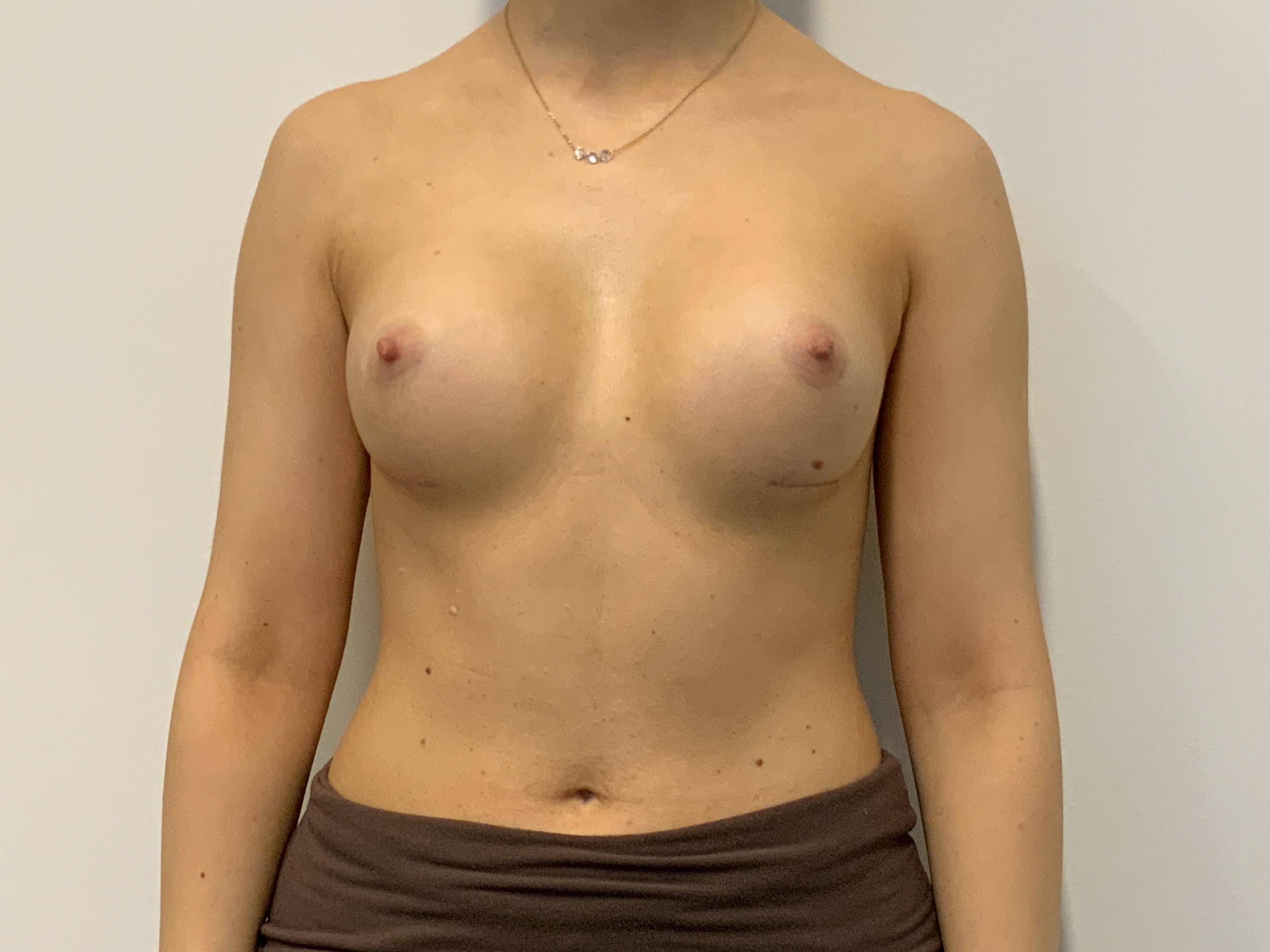 Breast Aug After