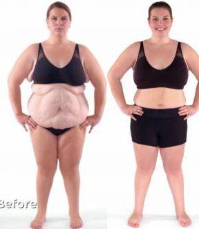 Abdominoplasty Case 12 Before