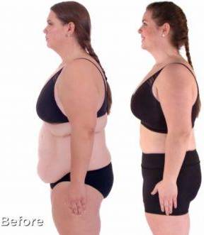 Abdominoplasty Case 12 After