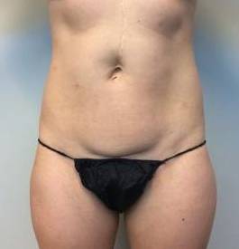 Abdominoplasty Case 13 Before