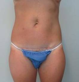 Abdominoplasty Case 13 After
