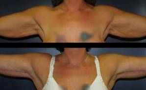 Arm Lift Case 1 