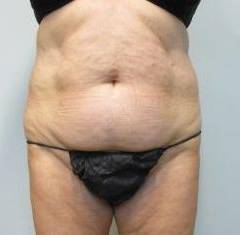Abdominoplasty Case 14 Before