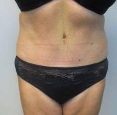 Abdominoplasty Case 14 After