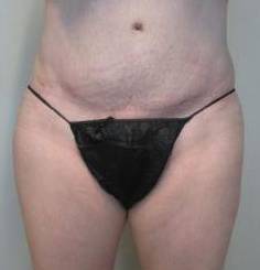 Abdominoplasty Case 15 After