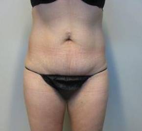 Abdominoplasty Case 16 Before