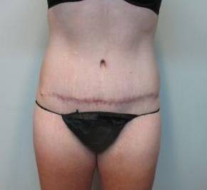 Abdominoplasty Case 16 After