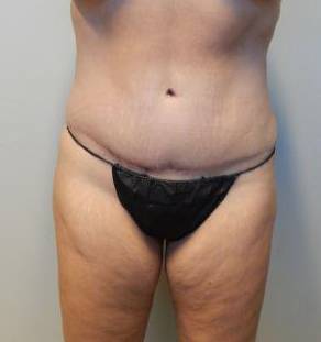 Abdominoplasty Case 17 After