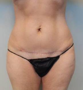 Abdominoplasty Case 18 After
