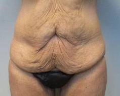 Abdominoplasty Case 19 Before