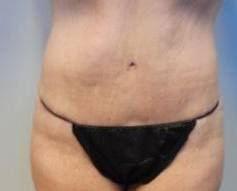 Abdominoplasty Case 19 After