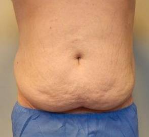 Abdominoplasty Case 20 Before