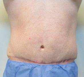 Abdominoplasty Case 20 After
