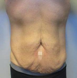 Abdominoplasty Case 21 Before