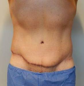 Abdominoplasty Case 21 After