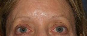 Brow Lift Case 4 Before