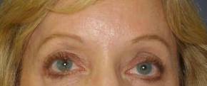Brow Lift Case 4 After