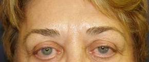 Brow Lift Case 3 Before