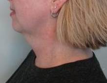 Liposuction Case 1-A Before