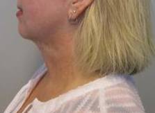 Liposuction Case 1-A After