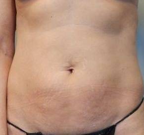 Abdominoplasty Case 22 Before