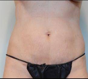 Abdominoplasty Case 22 After