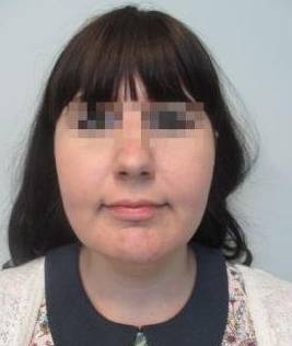 Liposuction Case 3-A Before