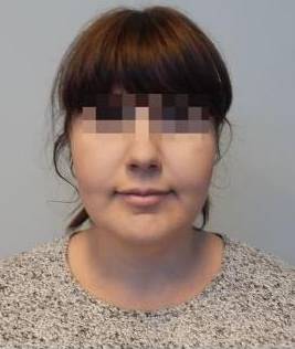 Liposuction Case 3-A After