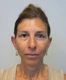 Otoplasty Case 2 Before