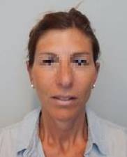 Otoplasty Case 2 After