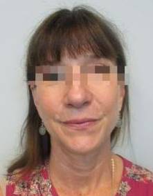 Rhinoplasty Case 5 Before
