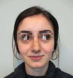 Rhinoplasty Case 4 Before