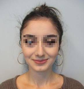 Rhinoplasty Case 4 After