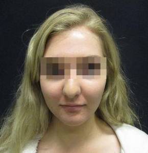 Rhinoplasty Case 7 Before
