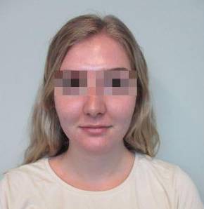 Rhinoplasty Case 7 After