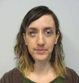 Rhinoplasty Case 6 Before