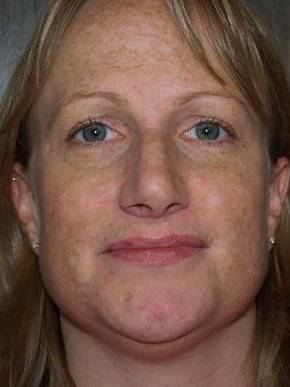 Rhinoplasty Case 3 Before