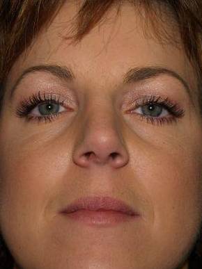 Rhinoplasty Case 2 After