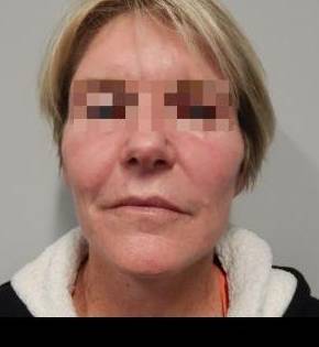 Face Lift Case 10 After